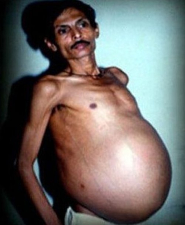 33-летнего Санджу Бхагата из Индии всю жизнь дразнили за огромный, словно беременный, живот.