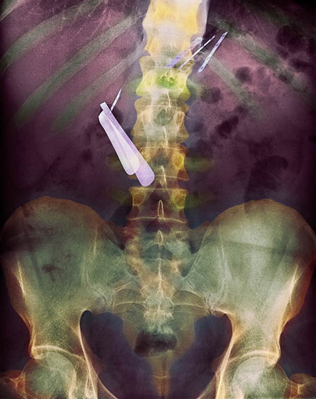 Цветной рентген желудка пациента, который проглотил бритву (по центру слева) и лезвия (вверху справа).