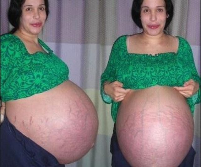 26 января 2009 года 33-летняя Нади Сулеман родила восьмерых близнецов, и все они оказались здоровы.