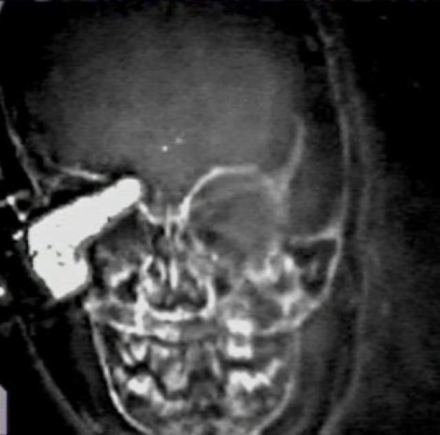 Рентген показал, что один из ключей проник ребенку в мозг. 