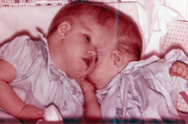 Лори и Джордж Шеппел , родились в 1961 году в США. У них все части тела свои, кроме одной - головы. Причем они разнополые. Дори стал первым сиамским близнецом в мире, который сменил пол. 