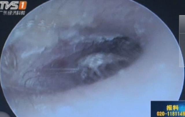 Сначала врачи извлекли из ушной раковины пациента самку таракана длиной 7,62 сантиметра, после чего обнаружили еще 25 ее отпрысков. По мнению врачей промедление могло бы привести к тому, что его ушная раковина была бы уничтожена.
