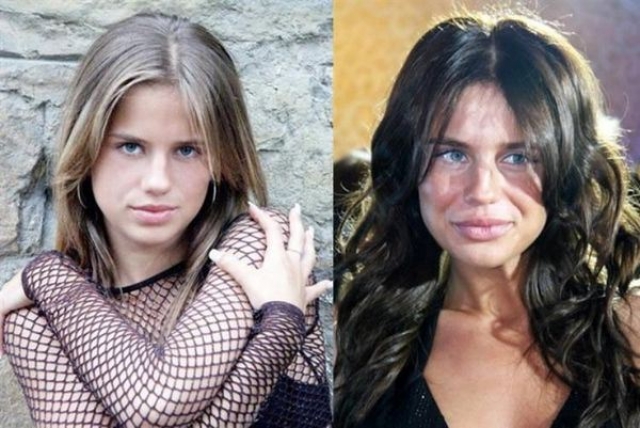 Алекса. Юная участница шоу "Фабрика Звезд-4" решила в 23 года стать похожей на своего модного кумира, Анджелину Джоли, для чего уменьшила нос и увеличила губы.