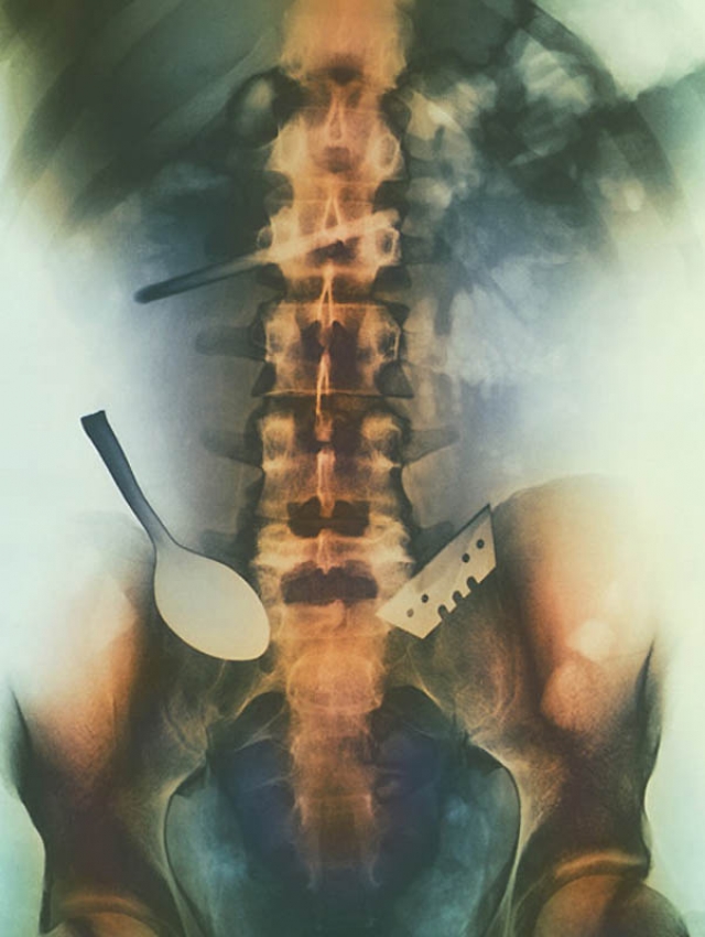 Цветной снимок предметов, которые проглотил пациент, и которые застряли в его кишечнике, включая ложку и лезвие.