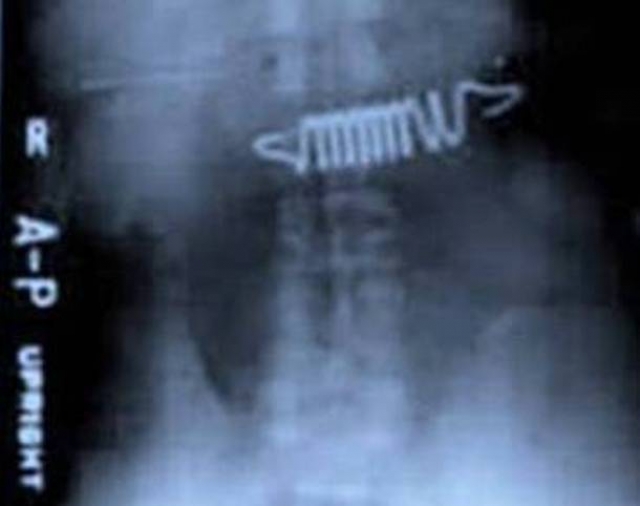 А это рентгеновский снимок из Центральной Тюрьмы в Роли, Северная Каролина. Заключенные часто глотали там различные предметы, например, пружины от кровати, показанные на снимке, чтобы их вывезли на операцию в больнице во внешнем мире.
