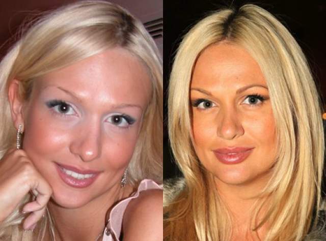Виктория Лопырева, 35 лет. Телеведущая пользовалась услугами пластических хирургов не единожды, но самая первая операция была именно по исправлению формы носа.