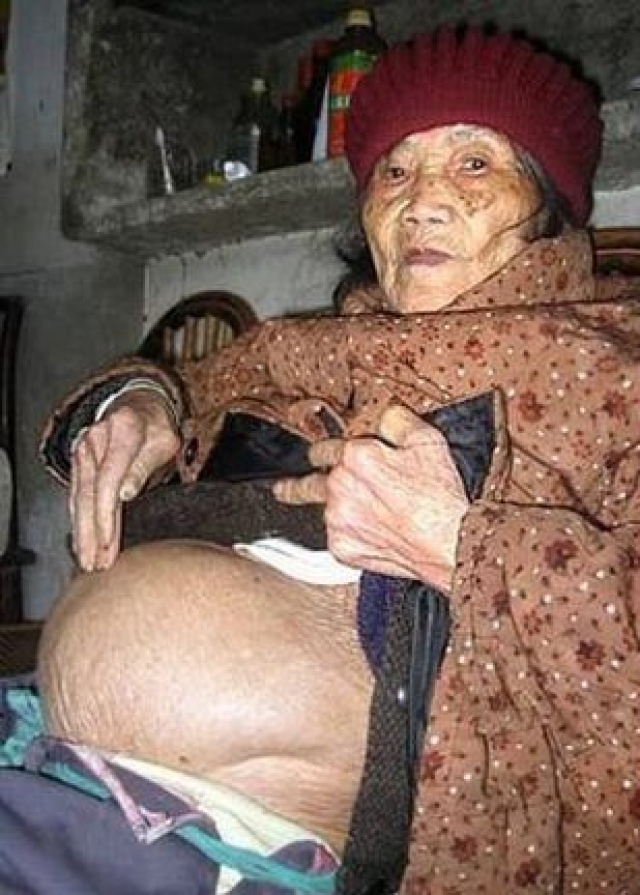Беременность длиною в жизнь. В январе 2009 года в больницу китайского города Хуангиаотан обратилась 92-летняя местная жительница Хуанг Юиджун, которая жаловалась на очень сильные боли в желудке.