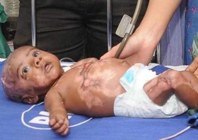Самовоспламеняющийся младенец  Этому индийскому мальчику было всего несколько  месяцев от роду, когда он поступил в больницу города Ченнаи (Индия). Его заболевание поставило врачей в тупик: мальчик страдает от спонтанных возгораний тела. 