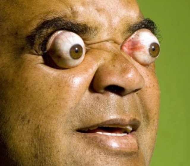 У мужчины - уникальная способность выпучивать глаза - глазное яблоко он может выдвинуть вперед на семь миллиметров, при этом становится видно почти 95 процентов глазного яблока.