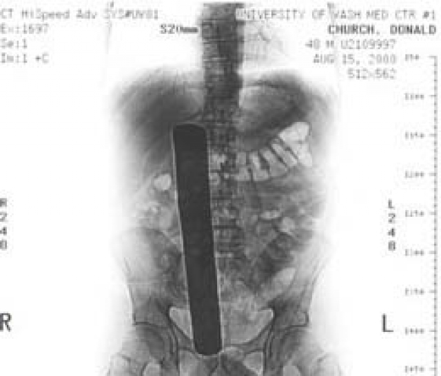 Когда его оперировали в 2000 году в Вашингтонском медицинском центре, в животе оставили хирургический инструмент 31 сантиметра в длину.