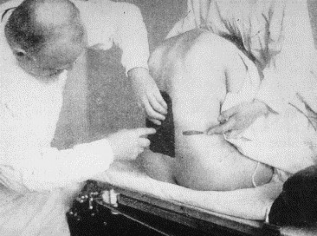 Эксперимент оказался успешным, но после того, как действие анестезии закончилось, оба мужчины почувствовали все симптомы, на которые жаловались их пациенты. Однако новая форма обезболивания прижилась в медицине.