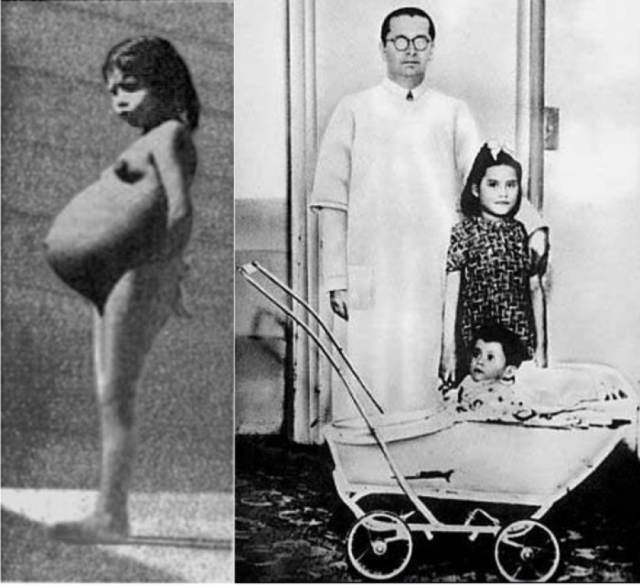 Лина Медина из Перу родила в 1939 году мальчика 2,7 кг с помощью кесарева сечения. Девочка - самая молодая мать в медицинской истории, родившая в возрасте 5 лет, 7 месяцев и 17 дней.