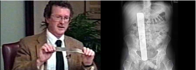 Дональд Черч сумел заработать на ошибке врачей 97 тысяч долларов. Когда его оперировали в 2000 году в Вашингтонском медицинском центре, в животе оставили хирургический инструмент 31 сантиметра в длину.