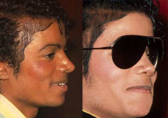 К 1982-му году была сделана еще одна ринопластика, а в 1984 году, когда восстановились после ожога кожа головы и волосы, была проведена четвертая пластика носа. 
