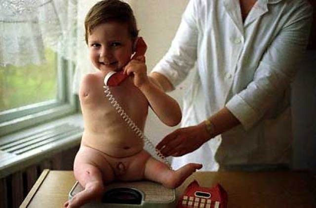 В 1988 году этого мальчика из белорусского дома для сирот сфотографировали и фото опубликовали в журнале Stern. Его усыновила английская семья. Мальчика прооперировали, и он смог адаптироваться к жизни.