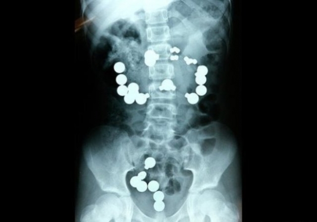 Восьмилетняя девочка Хэйли Лентс в 2009 году проглотила 20 стальных шариков и 10 магнитов, так как они выглядели для нее, как "конфеты". Из больницы ее выписали спустя две недели.