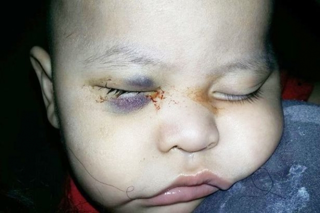 После того, как химиотерапия не помогла, левый глаз Вальдеса должен был быть удален. После операции, родители с ужасом обнаружили, что хирург удалил здоровый правый глаз мальчика.