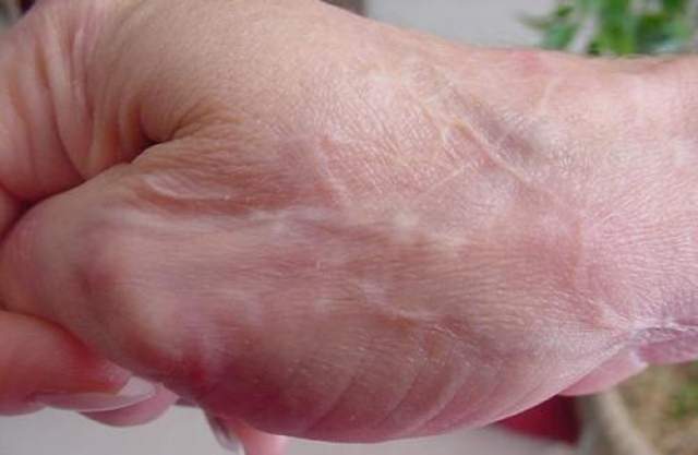 Болезнь Моргеллонов Характеризуется повреждениями кожи, при этом больные жалуются, что под их кожей ползают и кусаются насекомые или черви, а также утверждают, что находят у себя под кожей некие волокна. 