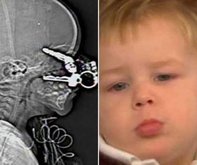 Ребенок остался невредимым после того, как связка металлических ключей пробила его голову  В сентябре 2008 года Николасу Холдермэну было только 17 месяцев, когда он упал в своем доме и приземлился на связку ключей. Один из ключей проколол его веко, проткнул глаз и пробился в его мозг.